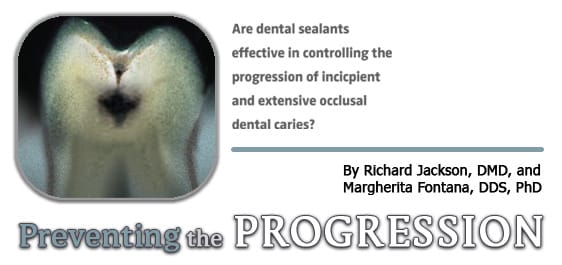 dental caries progression