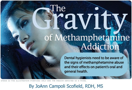 The Gravity of Methamphetamine Addiction Dimensions of Dental Hygiene