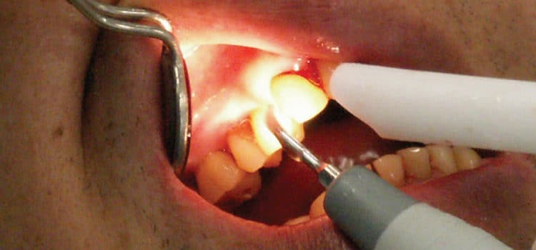 The Particulars of Piezo - Dimensions of Dental Hygiene