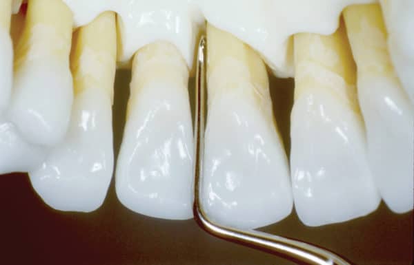 Key to Effective Calculus Removal - Dimensions of Dental Hygiene