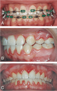 patient was referred to orthodontic treatment for esthetic