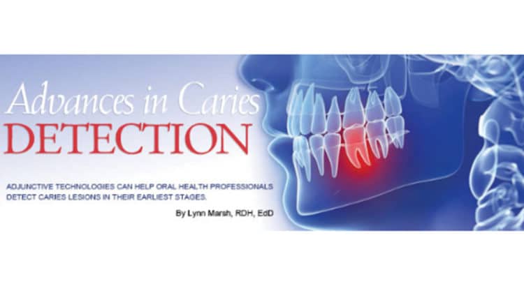 caries-featured