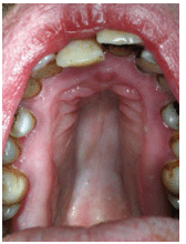 Palate of Patient with Marfan syndrome