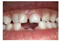 Tooth Abnormalities