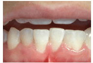 Signs of Tooth Abnormalities