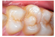 Tooth Abnormalities Image