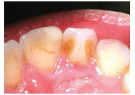 Tooth Abnormalities Cusp