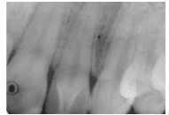 Radiograph of Tooth Abnormalities