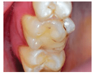 Tooth Abnormalities Accessory Cusp