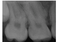 Tooth Abnormalities Radiograph