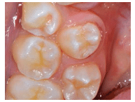 Tooth Abnormalities Crowding