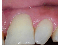 Tooth Abnormalities