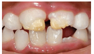 Tooth Abnromalities Due to Injury