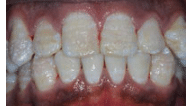 Fluorosis Tooth Abnormalities