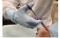 Administering Local Anesthesia