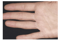 Types of Hand Dermatitis