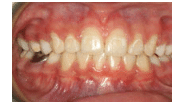 Decalcification from Orthodontic Appliance