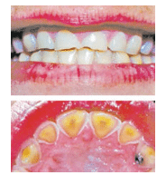 Erosion Due to Bulimia and Anorexia