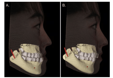 Predicted Effect for Orthodontics