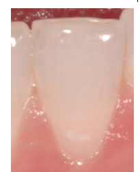 Minimally Invasive Dentistry Approach