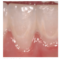 Minimally Invasive Dentistry