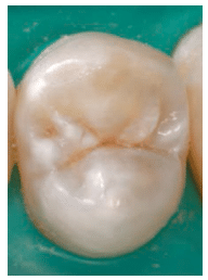 Minimally Invasive Dentistry Approach