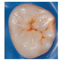 Minimally Invasive Dentistry Lesion