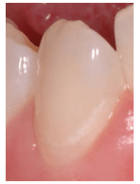 Minimally Invasive Dentistry Technique