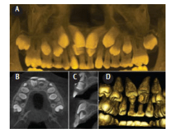 CBCT Scan