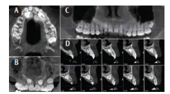 CBCT