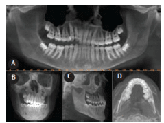 CBCT Panoramic