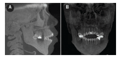 CBCT Scan