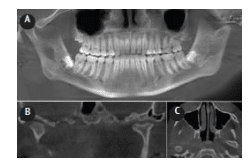 CBCT Reformatted Panoramic