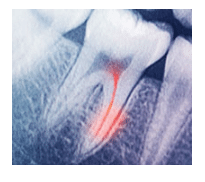 Dentinal Hypersensitivity