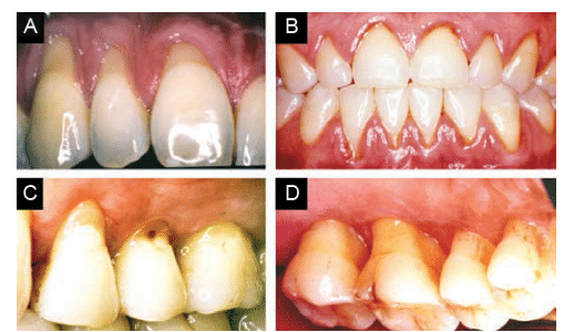 Causes of Dentinal Hypersensitivity