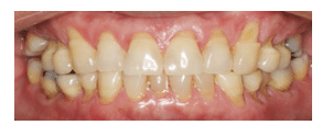 Noncarious cervical lesions