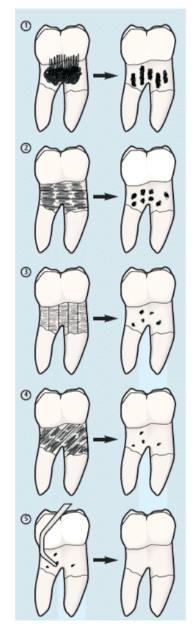 Ultrasonic Scaling Stroke Technique