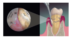 Instrumentation for Periodontal Maintenance