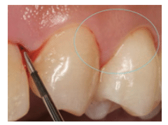 Instrumentation for Gingival Margin