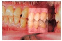 Dentinal Hypersensitivity