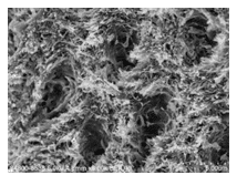 Active Caries Lesion Prior to Silver Diamine Fluoride (SDF)