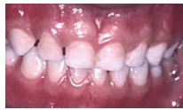 Diasteme, Gaps Between Teeth, in Primary Detention