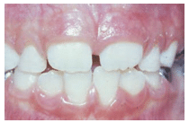 Midline Diastema, Gaps Between Teeth