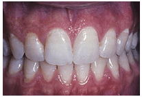 Closure of Gaps Between Teeth