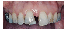 Closure of Gaps Between Teeth