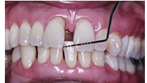 Formation Diastema, Gaps Between Teeth