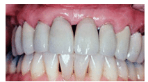 Closure of Diastema, Gaps Between Teeth