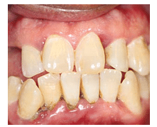 Gaps Between Teeth