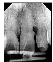 Tooth Migration