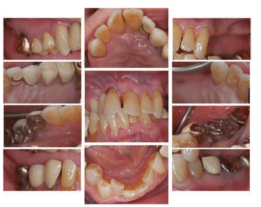 Clinical Presentation of Periodontal Treatment